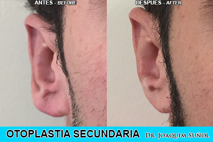 Otoplastia Secundaria - corecion Lobulos - Cirugia Estetica Secundaria - Dr. Joaquim Suñol