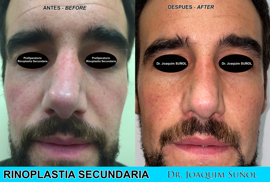 Rinoplastia-secundaria-cirugia-plastica-joaquim-sunol-resultados-nariz
