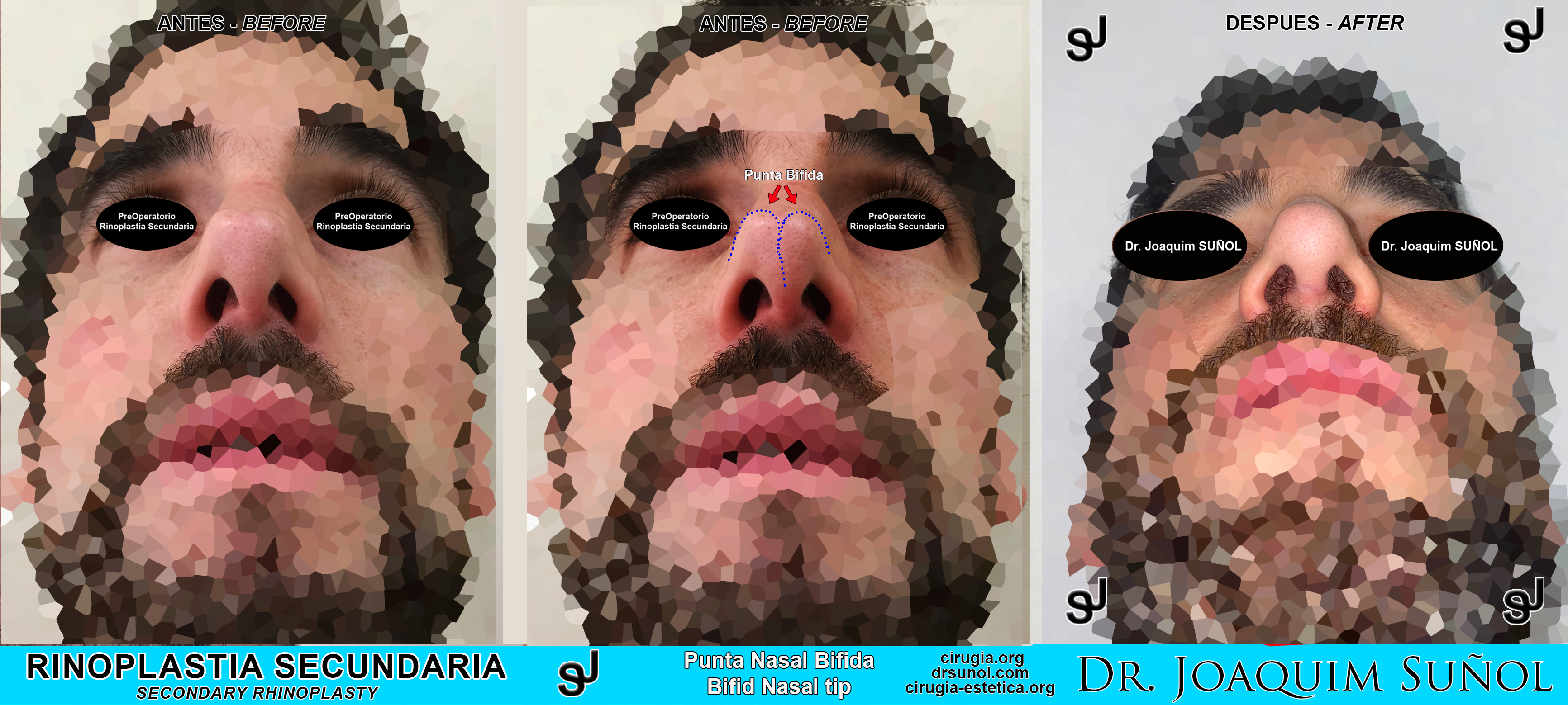 Rinoplastia-secundaria-resultados-nariz